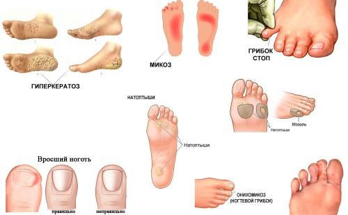 Fußhyperkeratose, Fußmykose, Fußpilz, Hühneraugen, Nagelpilz, eingewachsener Nagel