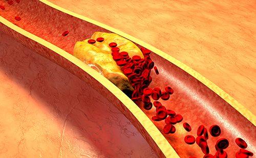 Plano ng arterya na kolesterol